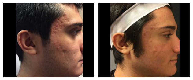 Acne Scar Treatements Acne Scar Treatements