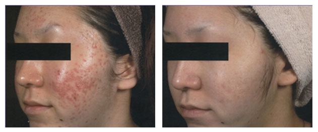 Acne scar Treatment