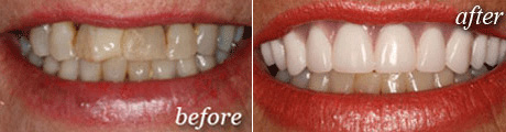 Dental Implants Before After Case 1