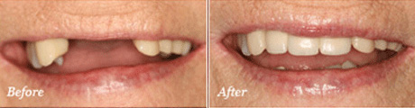Dental Implants Before After Case 2