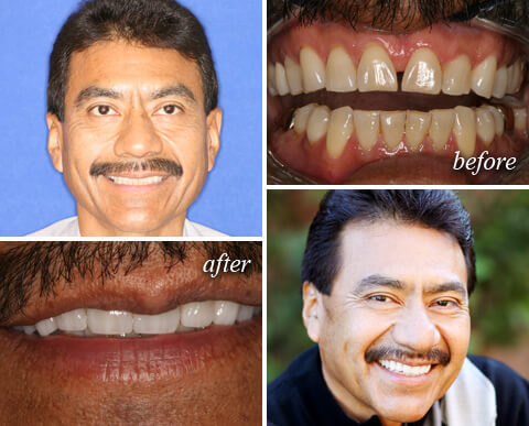 Before After 06