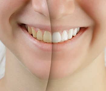 Teeth whitening with your dentist in Phoenix can rejuvenate the whole face in about an hour