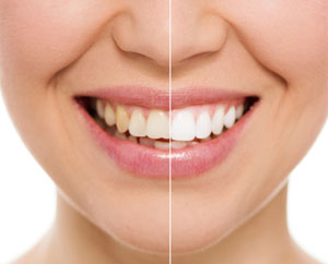 Phoenix, AZ area practice offers professional tooth whitening services