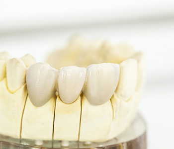 Dental Caps Restoration Phoenix AZ