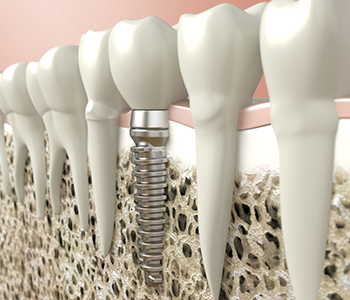 Patients in Phoenix see benefits of dental implants over dentures