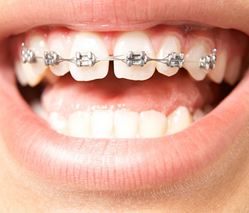 Best Candidates for Six Month Smiles Near Me Glendale