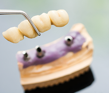 Phoenix patient asks, “Who is the best candidate for a dental crown or caps?”