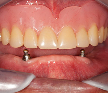 Phoenix dentist describes the best candidates for dental implants