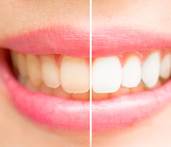 Patient in Phoenix asks, ‘How would I find the best dentist for teeth whitening?’