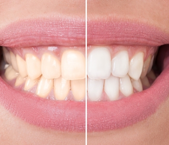 When is “one hour teeth whitening” the best method for Phoenix smiles?