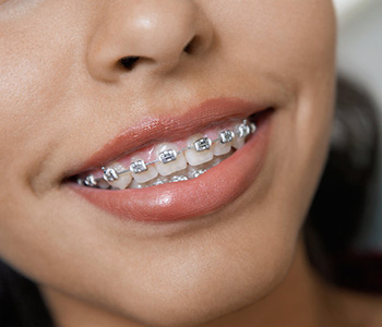 Braces Cost Glendale