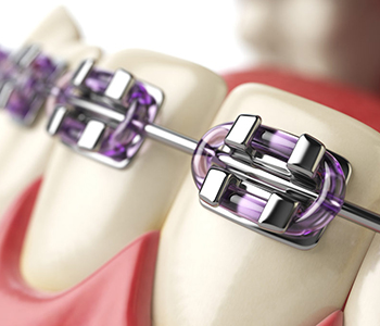 Braces Phoenix AZ