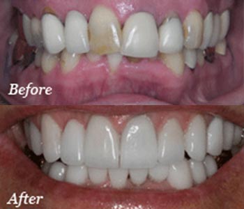 Phoenix dentistry offers cosmetic fillings for beautiful smiles