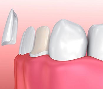 Phoenix, AZ dentist uses veneers for cosmetic enhancement of the smile