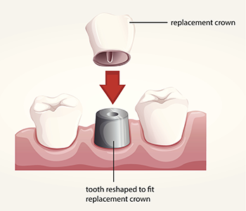 Do Glendale area residents have an alternative to dental crowns and bridges?