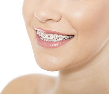 Dental Braces Glendale