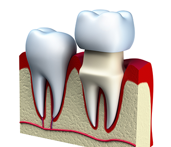 Dental Crowns