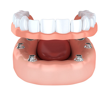 A dental implant is the preferred tooth replacement in Phoenix