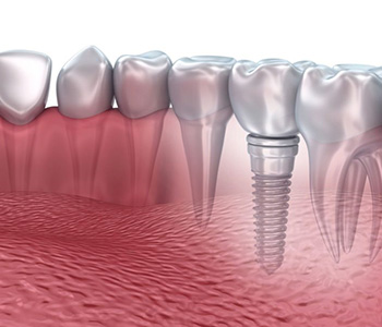The concealed benefit of dental implants in Arizona