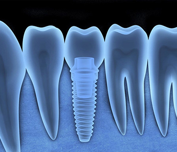 The advantages of Phoenix AZ dental implants