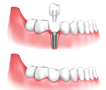 Dental Implant Surgery