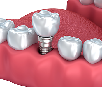 Patient in Phoenix asks, “How does a dental crown procedure work?”
