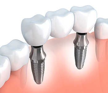 Choosing an implant dentist in the Glendale area