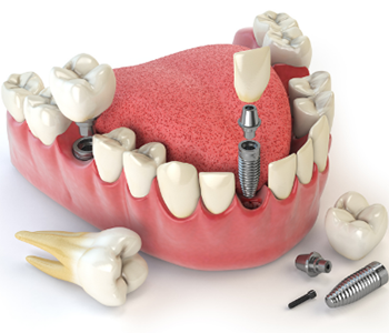 Phoenix, AZ dentist offers the dental implant for tooth replacement
