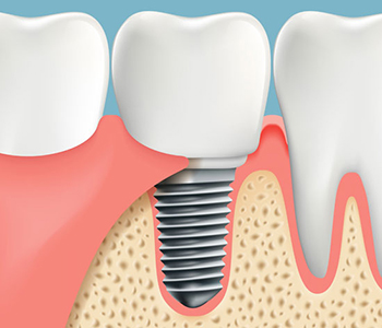 Implants Can Prevent The Problems That Missing Teeth May Cause