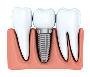 Implant Dentistry Arizona