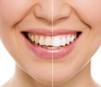 Phoenix area patients can enjoy single visit cosmetic dentistry at Biltmore Dental Center