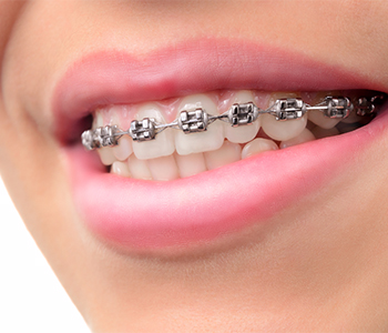 Phoenix Braces