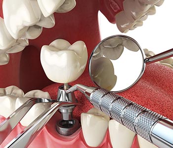 Patients in Phoenix ask, “Where can I find same day completion of dental implants near me?”