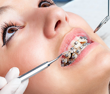 Six Month Braces Glendale
