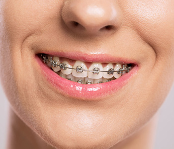 Six Month Braces Phoenix