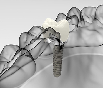 Phoenix, AZ area dentist offers snap-in dentures