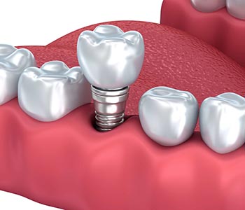 The pros and cons of implant dentistry in the Phoenix area
