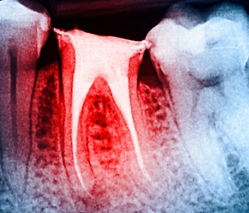 Phoenix doctor offers tips to avoid tooth decay