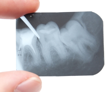 Root canal treatment in Glendale for advanced tooth decay