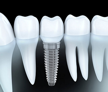 Phoenix, AZ dentist provides tooth implant options