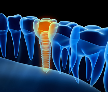 Options for tooth replacement in the Phoenix area