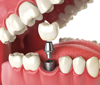 The most popular option for tooth replacement in Phoenix