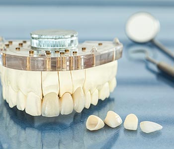 How affordable is the cost of veneers in Phoenix, AZ