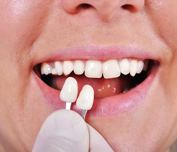 Enjoy an exquisite smile with porcelain veneers of Phoenix