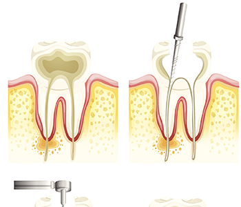 Benefits of Root Canals