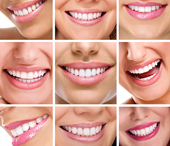 Benefits of Teeth Whitening