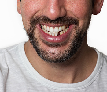 Advice for patients in the Phoenix area for repair of a broken tooth
