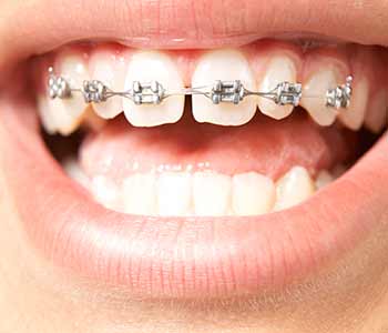 Cosmetic dentistry in Phoenix: Treatment options for gapped teeth