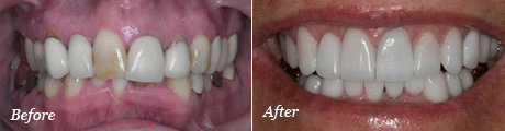 Biltmore Dental Center After Dental Crowns