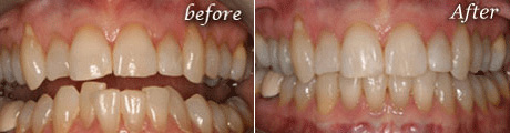 Root Canal before treatment, 